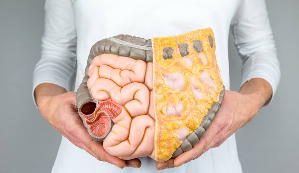 Overlooked Reason for Colon Cancer and GI Tract Upset about undefined