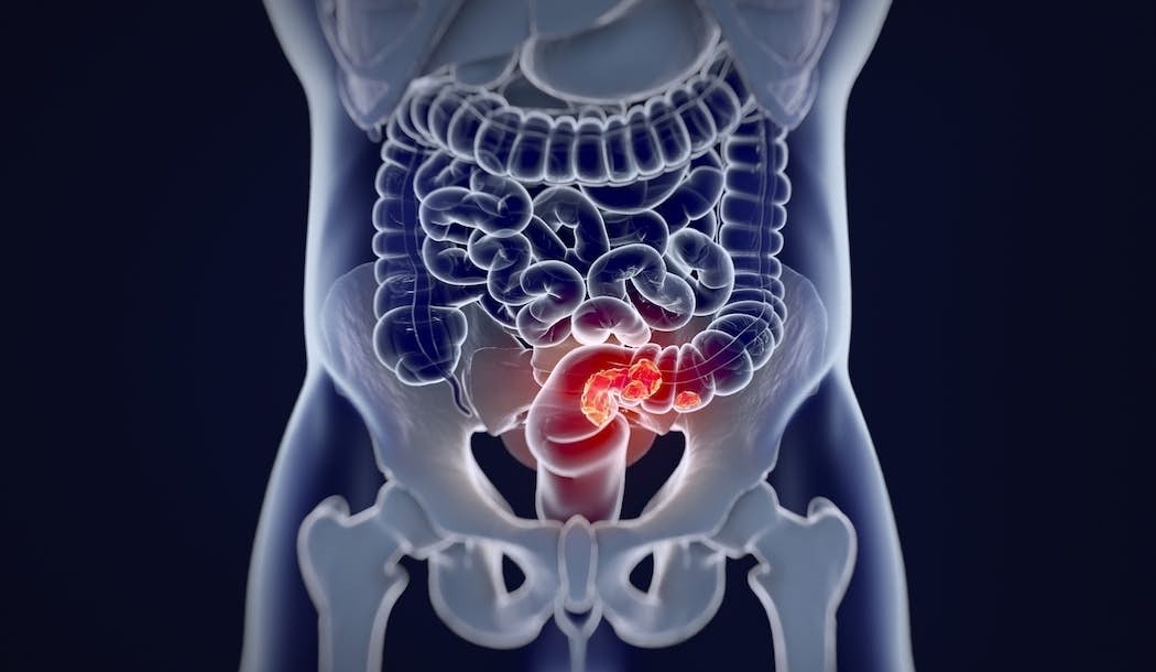 Your First Line of Defense Against Colorectal Cancer – How Strong is Yours? about undefined