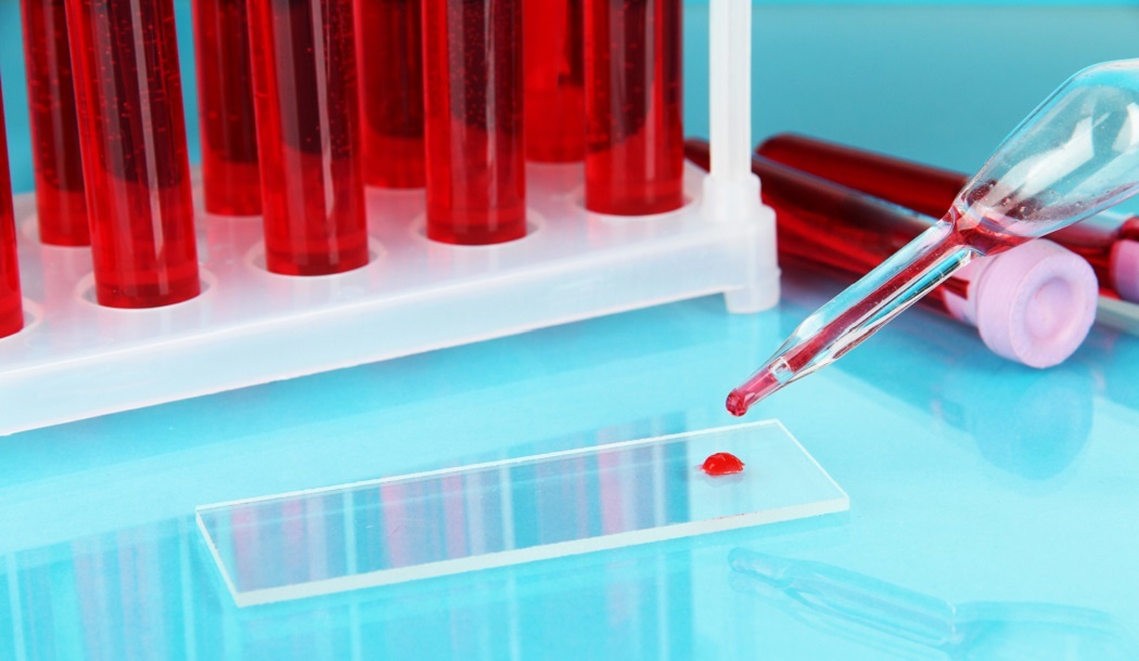 Is Cancer in Your Future? A Simple Blood Test May be Able to Tell about undefined