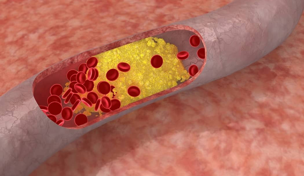Cholesterol and Cancer: Murky, Perhaps Dangerous, Connections about undefined