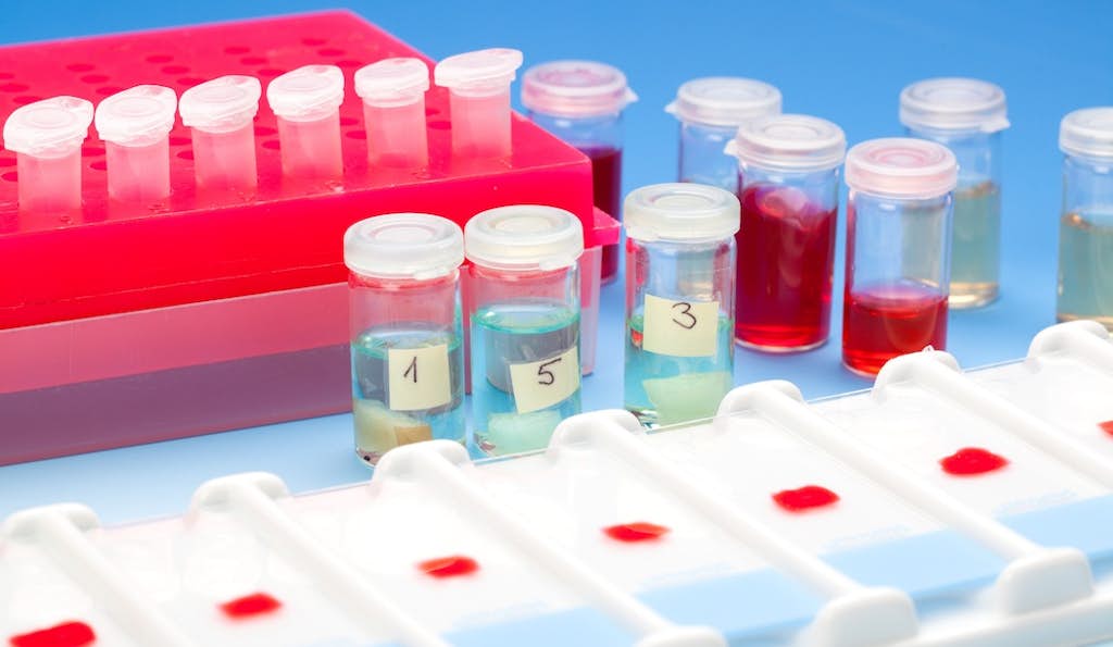 Next Generation Blood Test May Hold  the Key to Detecting Cancer at its Earliest about false